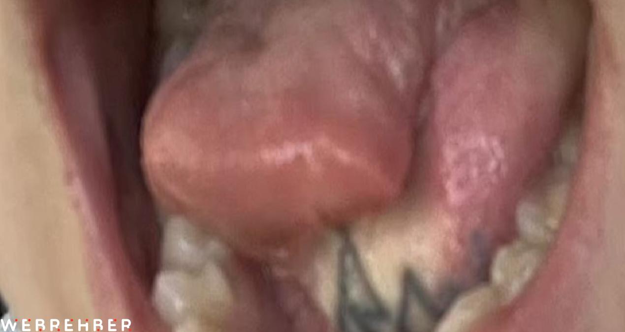 Ağız sorunu yüzünden diline kolundan yama yaptılar! Hem de dövmeyle beraber
