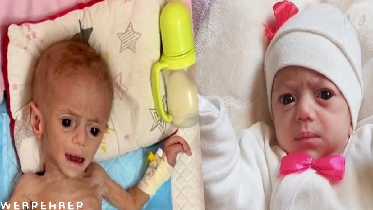 Gazze’de beş aylık Suvar Aşur, yetersiz beslenme yüzünden ölümle burun buruna