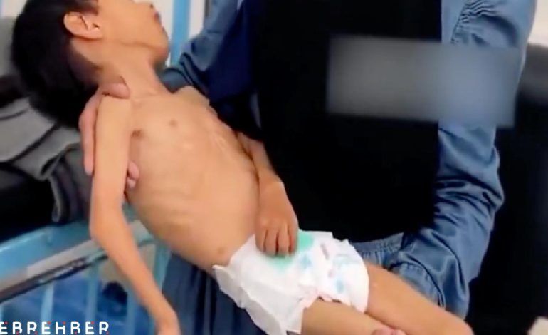Gazze’de bir çocuk daha yetersiz beslenme nedeniyle yaşam savaşı veriyor