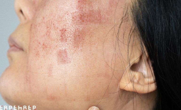 Lupus hastalığı hakkında bilmeniz gerekenler
